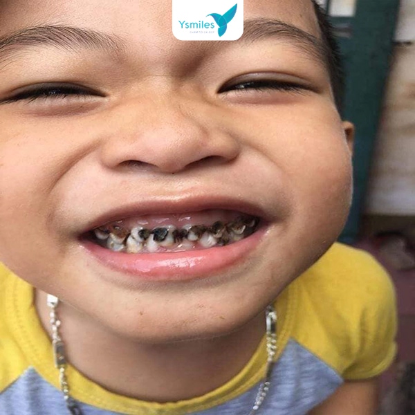 nha khoa điều trị sâu răng cho bé