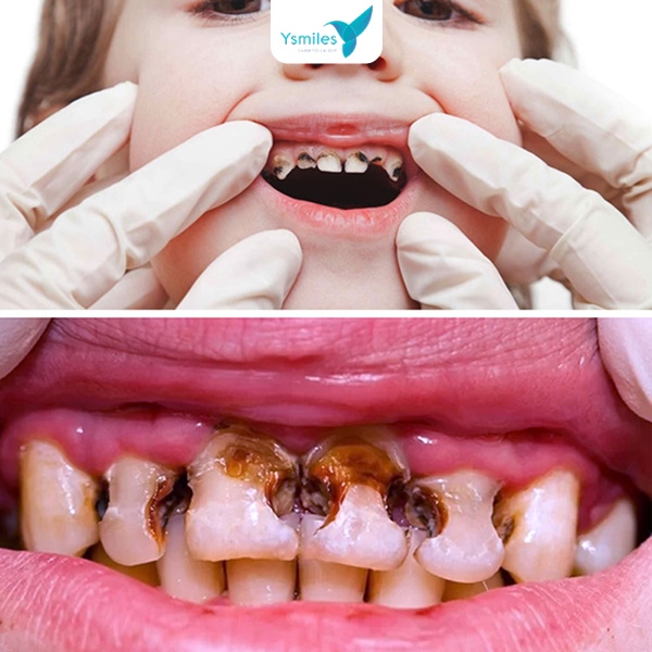 răng sữa bị sâu ở trẻ nhỏ