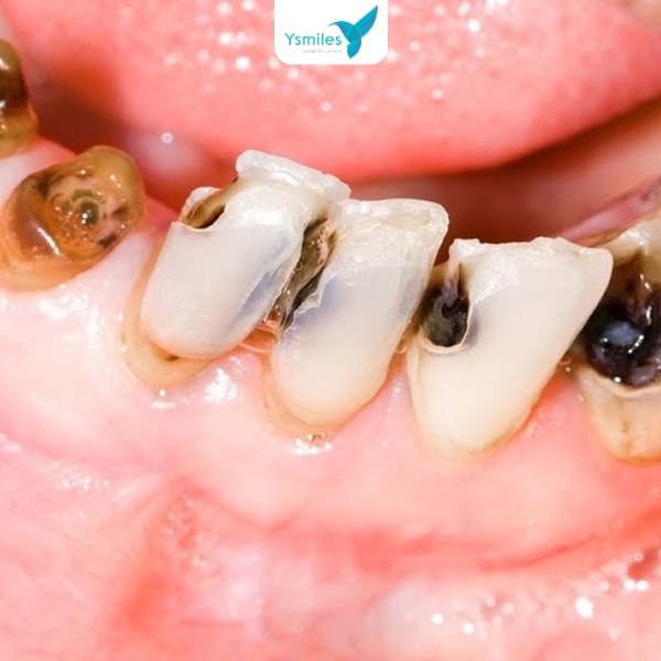 điều trị sâu răng an toàn cho bé