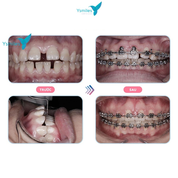Hình ảnh trước và trong quá trình chỉnh nha
