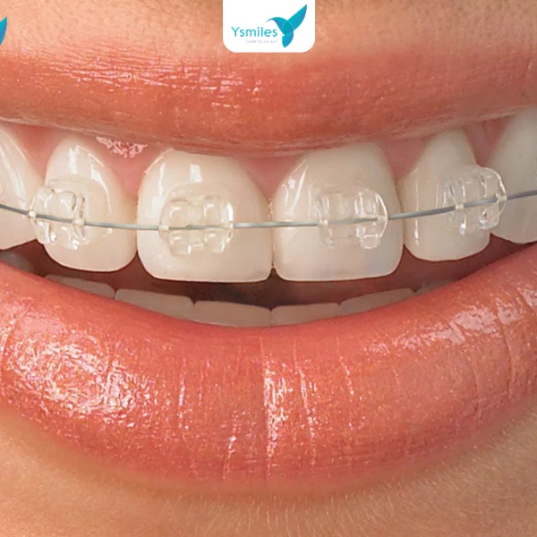 tư vấn lựa chọn phương pháp chỉnh nha phù hợp