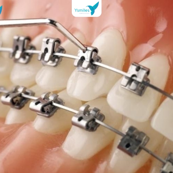 mẫu mắc cài kim loại dùng trong chỉnh nha