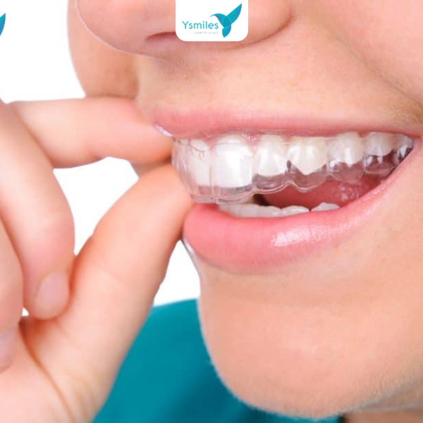 khay niềng trong suốt dùng để chỉnh nha