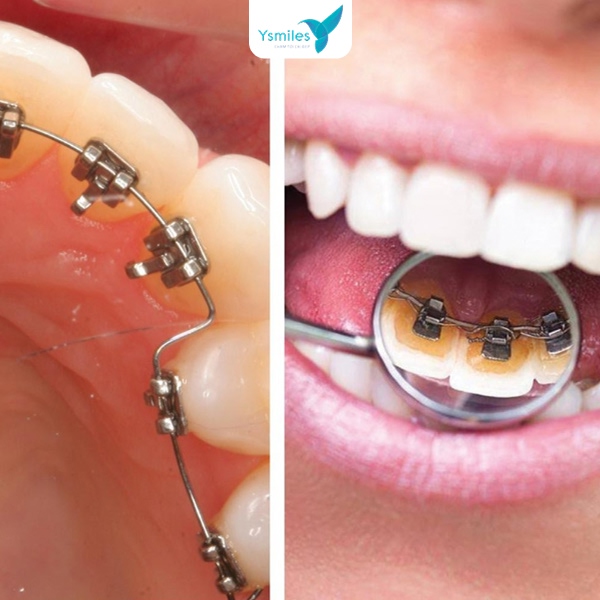 hình ảnh khách hàng đang đeo mắc cài