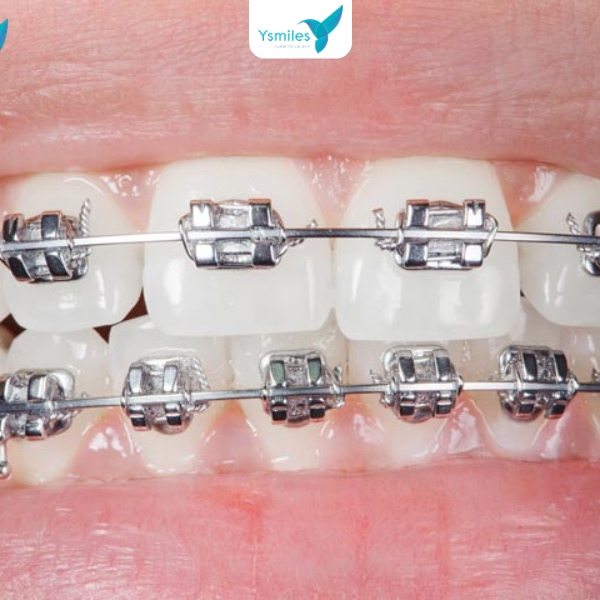 Hình ảnh kết quả răng thẳng đều sau chỉnh nha