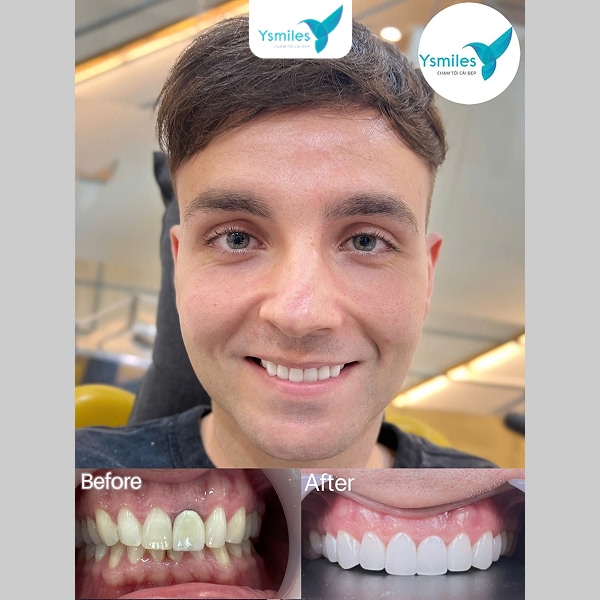 Nha sĩ tư vấn chuyên sâu về giá bọc răng sứ thẩm mỹ và gói ưu đãi