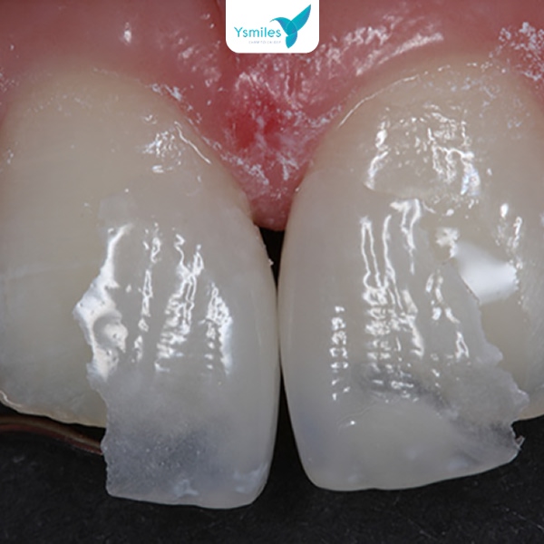 Nha sĩ tư vấn chuyên sâu về giá bọc răng sứ thẩm mỹ và gói ưu đãi