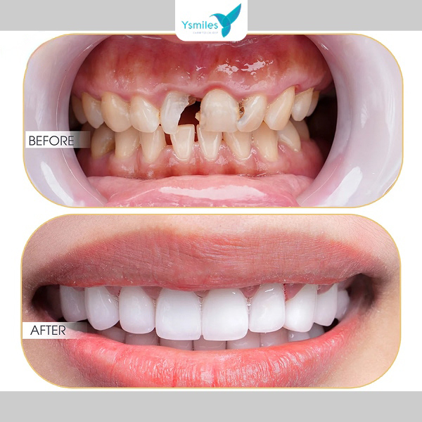 Hình ảnh trước và sau khi trồng Implant - Thay đổi ngoạn mục, lấy lại sự tự tin.