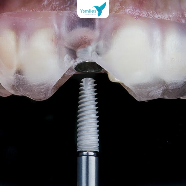 Trụ Implant cao cấp được Ysmile sử dụng trong dịch vụ trồng răng Implant