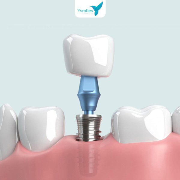 Quy trình trồng răng Implant chuẩn y khoa, đảm bảo an toàn tuyệt đối và hiệu quả thẩm mỹ cao