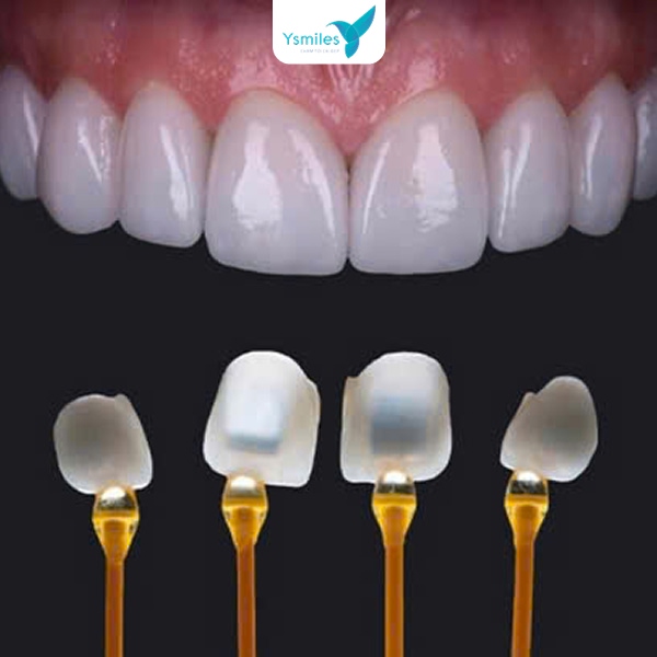 Quy trình chuẩn bị răng an toàn và nhẹ nhàng trước khi bọc răng sứ thẩm mỹ