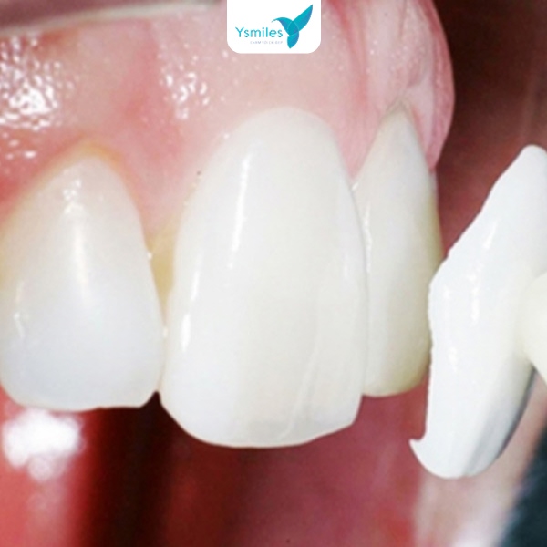 Chỉnh sửa và căn chỉnh răng sứ theo khuôn mặt trước khi lắp răng sứ thẩm mỹ