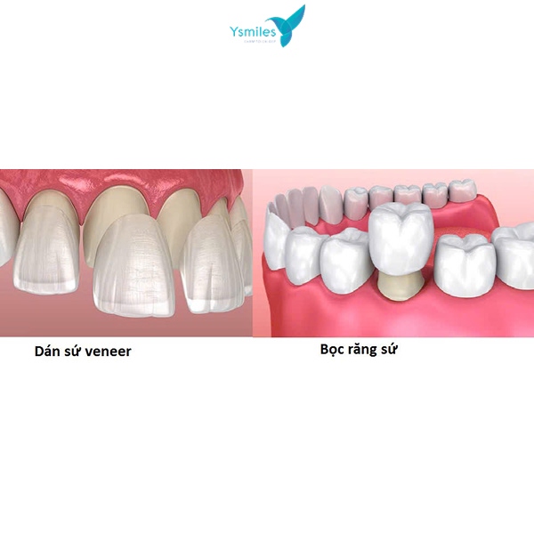 Giải pháp dán sứ veneer thẩm mỹ, ít xâm lấn hơn bọc răng sứ thẩm mỹ