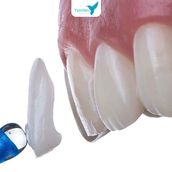 Độ bền vượt trội và tuổi thọ lâu dài của vật liệu răng sứ thẩm mỹ cao cấp