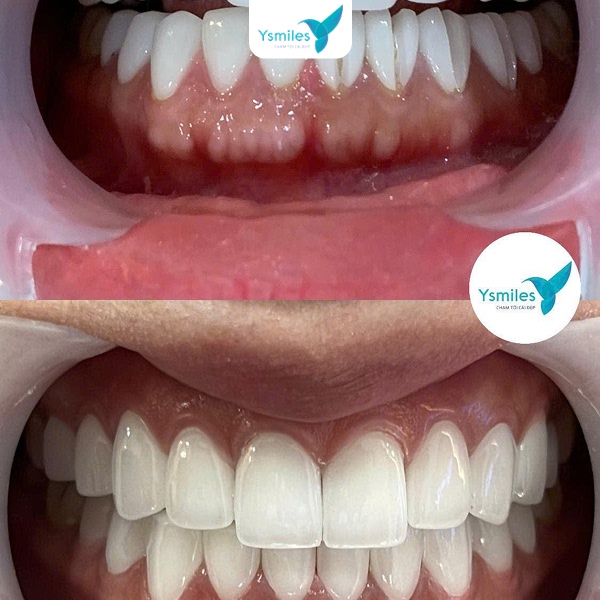Tự tin rạng ngời với nụ cười hoàn hảo từ dịch vụ răng sứ thẩm mỹ