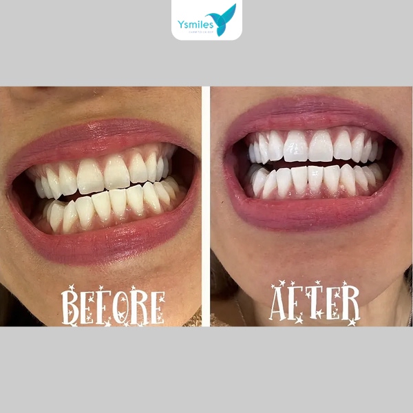 Quy trình tẩy trắng răng tại Ysmiles đạt chuẩn