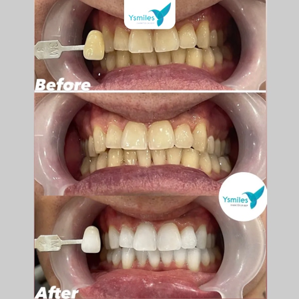 Điều cần chú ý sau khi tẩy trắng răng để duy trì hiệu quả lâu dài
