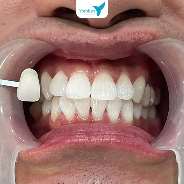 Kinh nghiệm chọn nơi tẩy trắng răng uy tín, an toàn