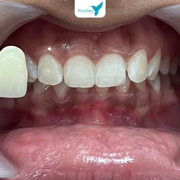 Tẩy trắng răng giúp răng sáng bóng, mang lại nụ cười đẹp và tự tin