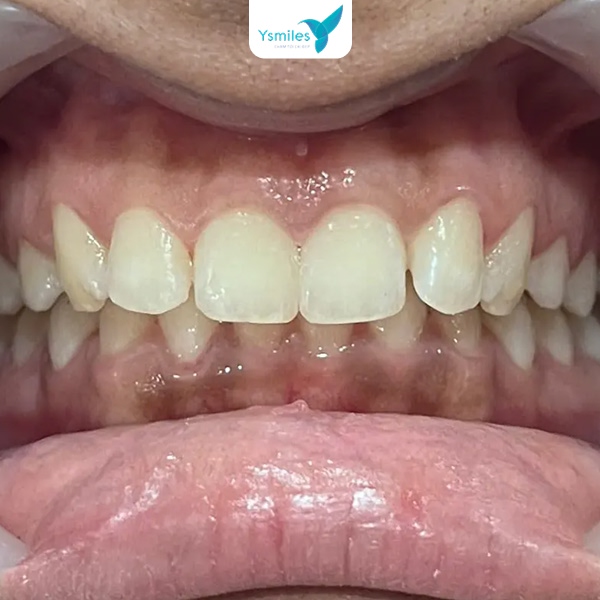 Răng yếu hoặc bị sâu răng, mòn men khiến tình trạng ê buốt dễ xảy ra