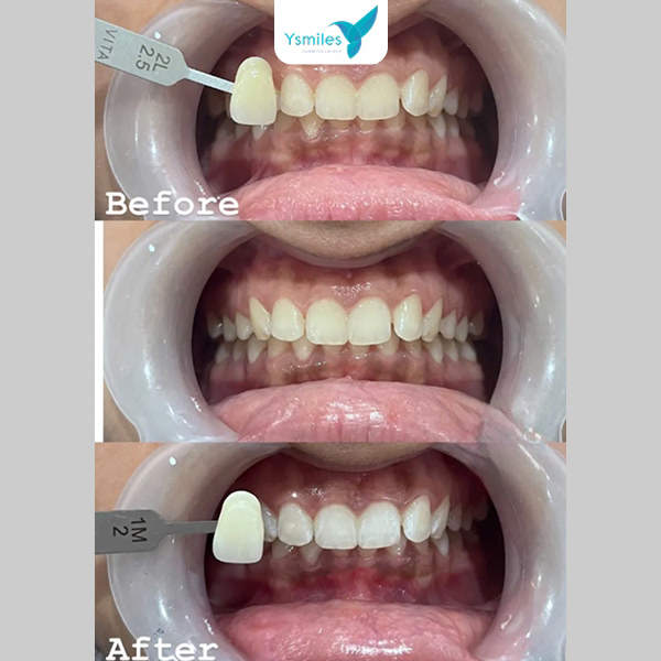 Dùng kem đánh răng cho răng nhạy cảm để giảm kích ứng sau khi tẩy trắng