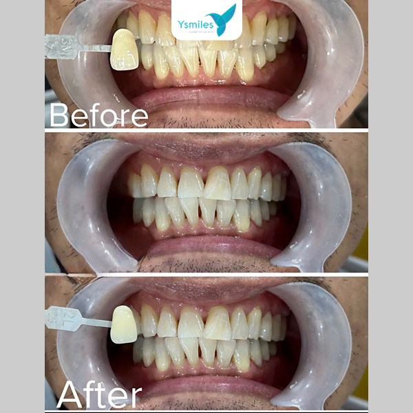 Khám và điều trị răng miệng trước giúp giảm ê buốt khi tẩy trắng răng