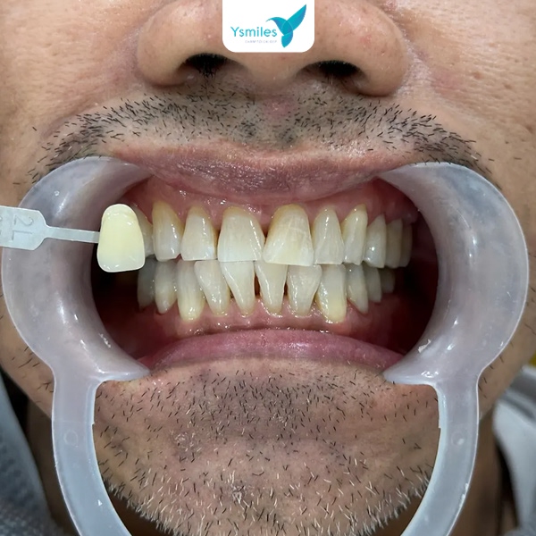 Ăn uống đúng cách sau tẩy trắng răng giúp duy trì trắng sáng hiệu quả