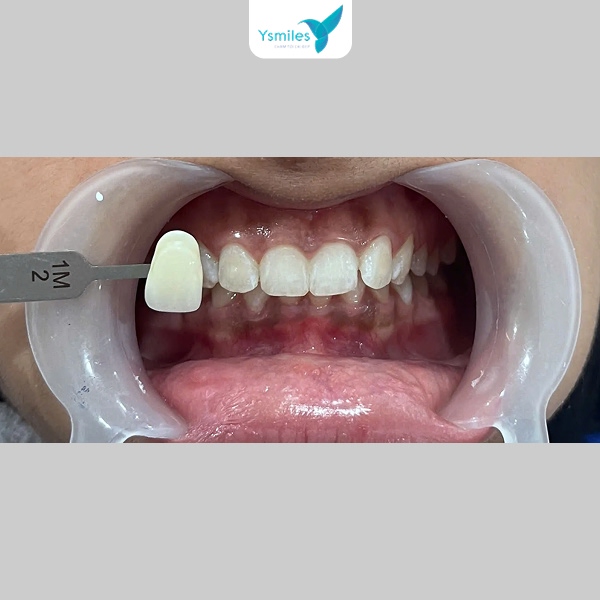 Ưu tiên thực phẩm ít màu, dễ tiêu hóa để bảo vệ men răng sau tẩy trắng