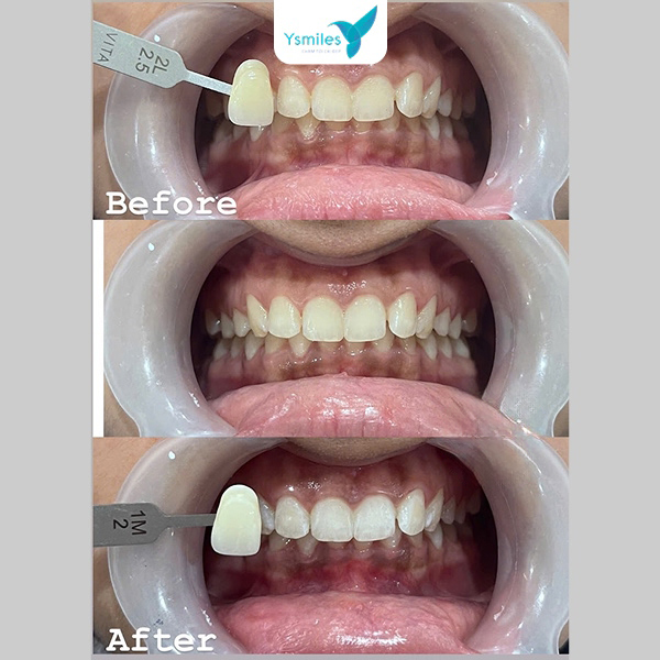 Hút thuốc lá trong 2 tuần đầu sau tẩy trắng răng có thể làm ố vàng nhanh