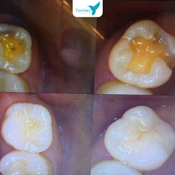 Lời khuyên sau khi trám răng về trường hợp dùng thuốc tê