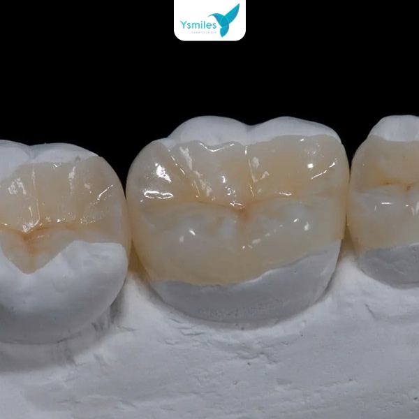 Trường hợp trám răng không dùng thuốc tê và vật liệu Composite