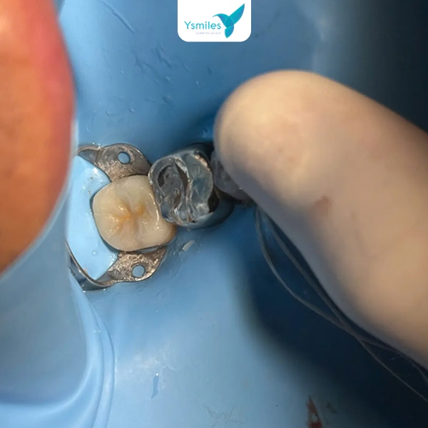 Thực phẩm nên kiêng sau trám răng