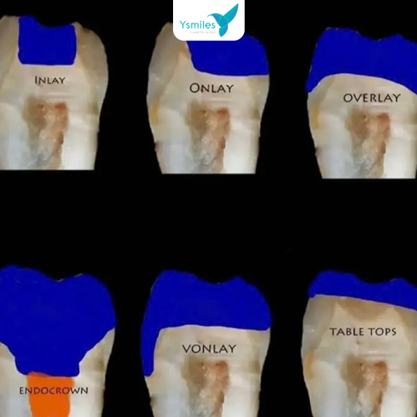 Chú ý các dấu hiệu bất thường sau trám răng