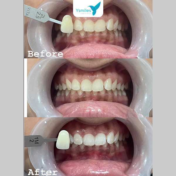 Tẩy trắng răng giúp cải thiện nụ cười và mang lại sự tự tin khi giao tiếp