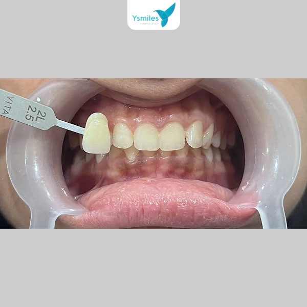 Tẩy trắng răng phá vỡ sắc tố mà không ảnh hưởng cấu trúc men và ngà răng