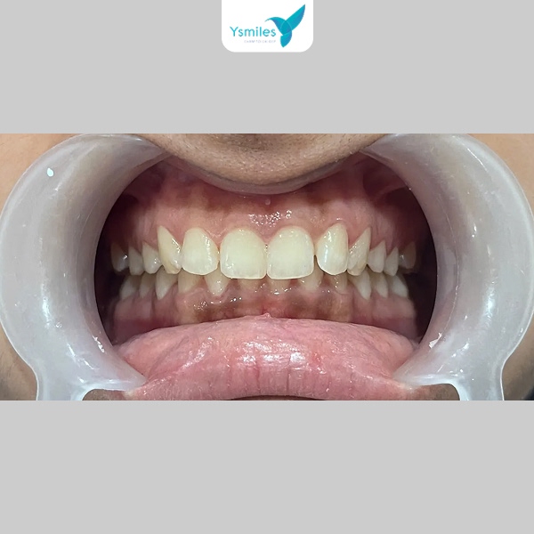 Ê buốt và răng nhạy cảm là tác dụng phụ phổ biến sau khi tẩy trắng