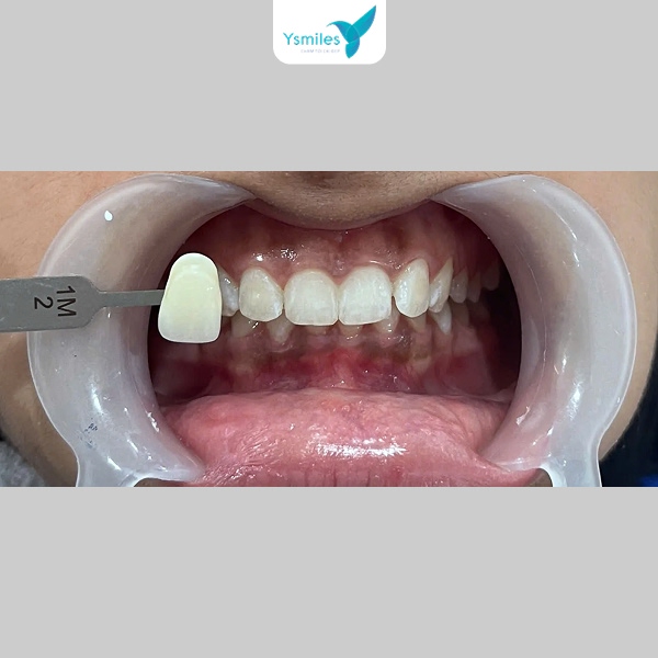 Trẻ em dưới 16 tuổi không nên tẩy trắng do tủy răng chưa ổn định