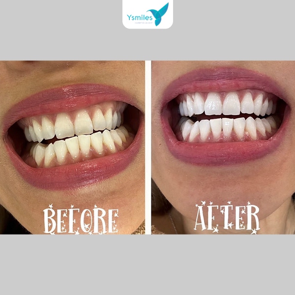 Chế độ ăn sau khi tẩy trắng răng quyết định độ trắng sáng của răng