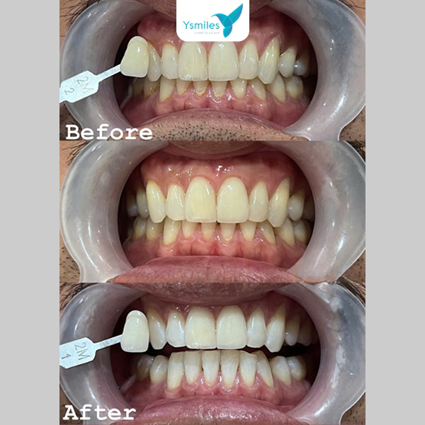 Răng sau tẩy trắng dễ kích ứng khi ăn đồ nóng, lạnh hoặc có vị chua