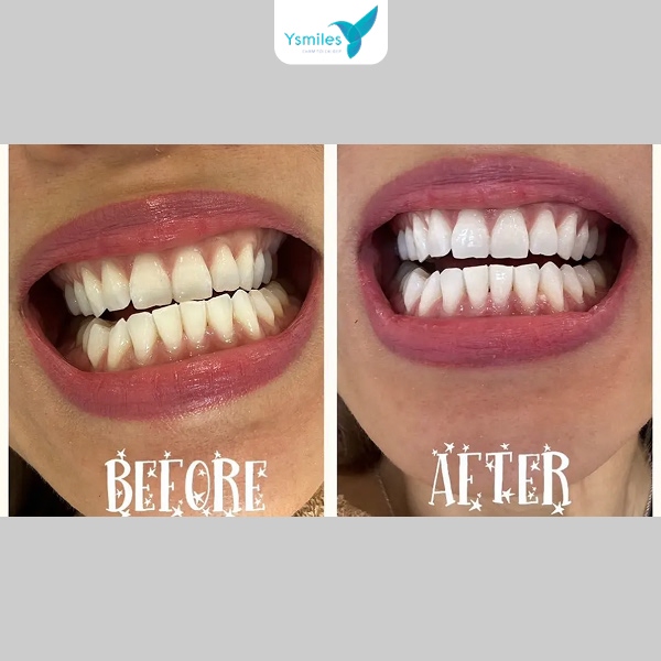 Răng ố vàng lâu năm cần đến nha khoa để được tẩy trắng chuyên nghiệp hơn