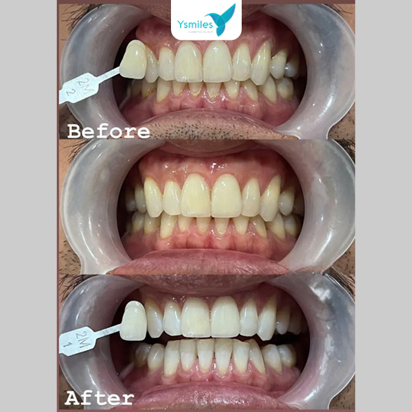 Hiện nay có nhiều phương pháp tẩy trắng răng phù hợp với từng nhu cầu