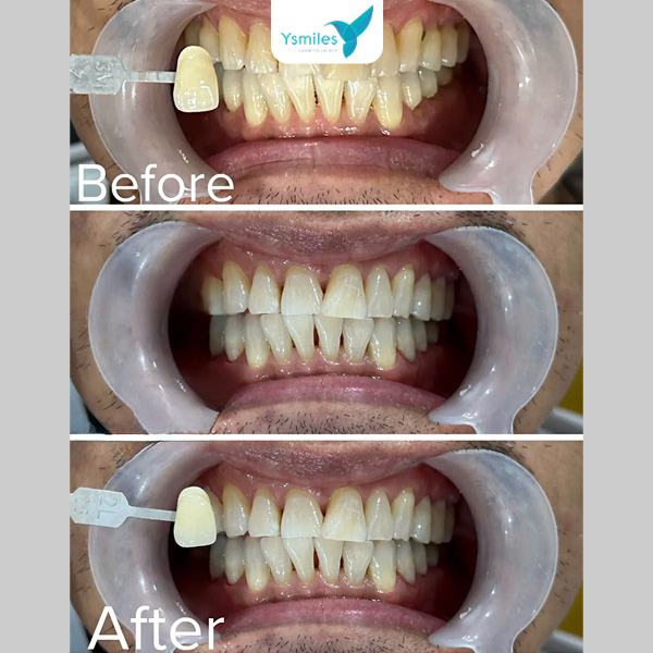 Chi phí tẩy trắng răng thay đổi tùy theo phương pháp và cơ sở nha khoa