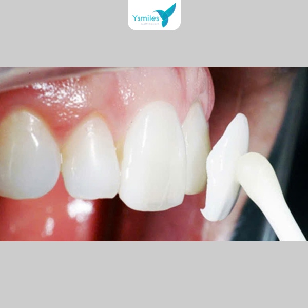 Trám răng Composite là phương pháp phổ biến, được nhiều người tin dùng