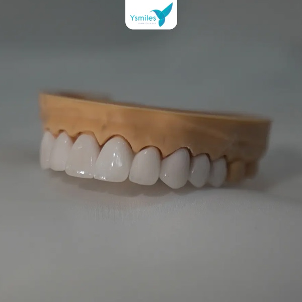 Miếng trám Composite chịu được lực ăn nhai, đảm bảo an toàn cho miệng