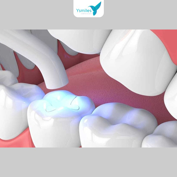 Trám răng Composite tạo hình tự nhiên, màu giống men răng thật