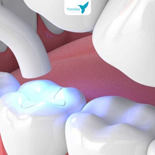 Ysmiles là nha khoa uy tín tại TP.HCM chuyên trám răng thẩm mỹ chất lượng