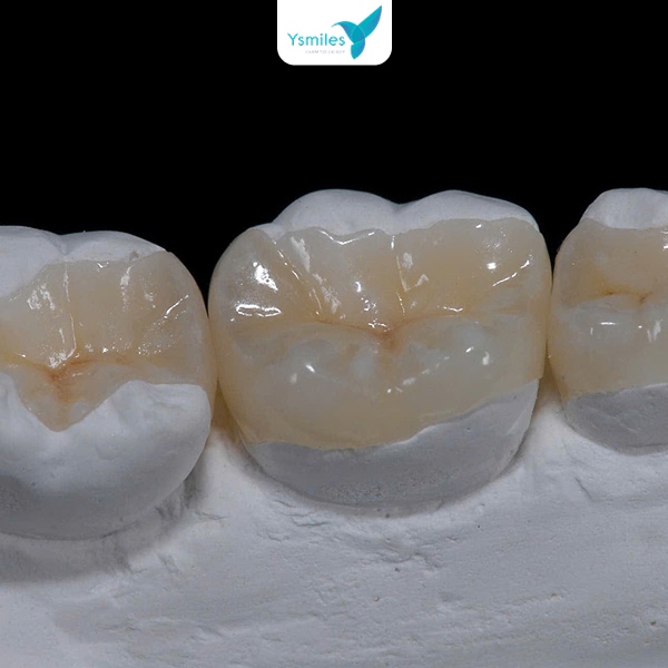 Trám răng là phương pháp nha khoa giúp phục hồi răng bị sâu, mẻ hay thưa