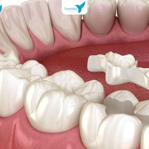 Trám răng giúp điều trị sâu răng, ngăn vi khuẩn xâm nhập và bảo vệ tủy