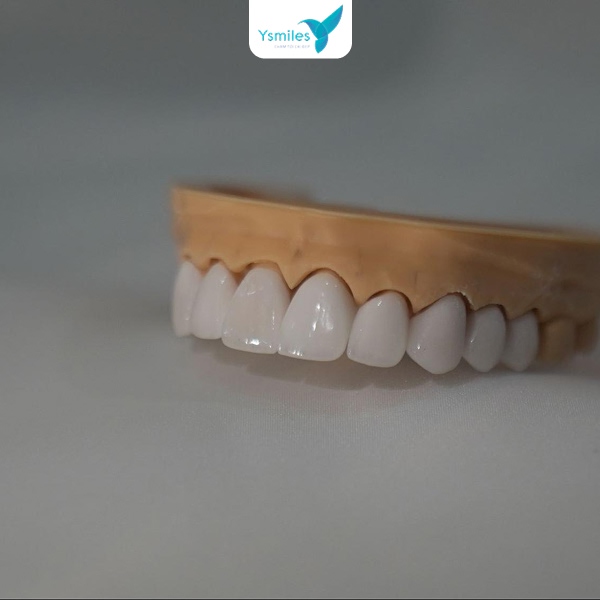 Vật liệu trám hiện đại giúp phục hình răng đẹp, bền và tự nhiên