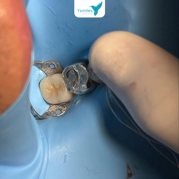 Quy trình trám răng được thực hiện tuần tự, đảm bảo thẩm mỹ và an toàn